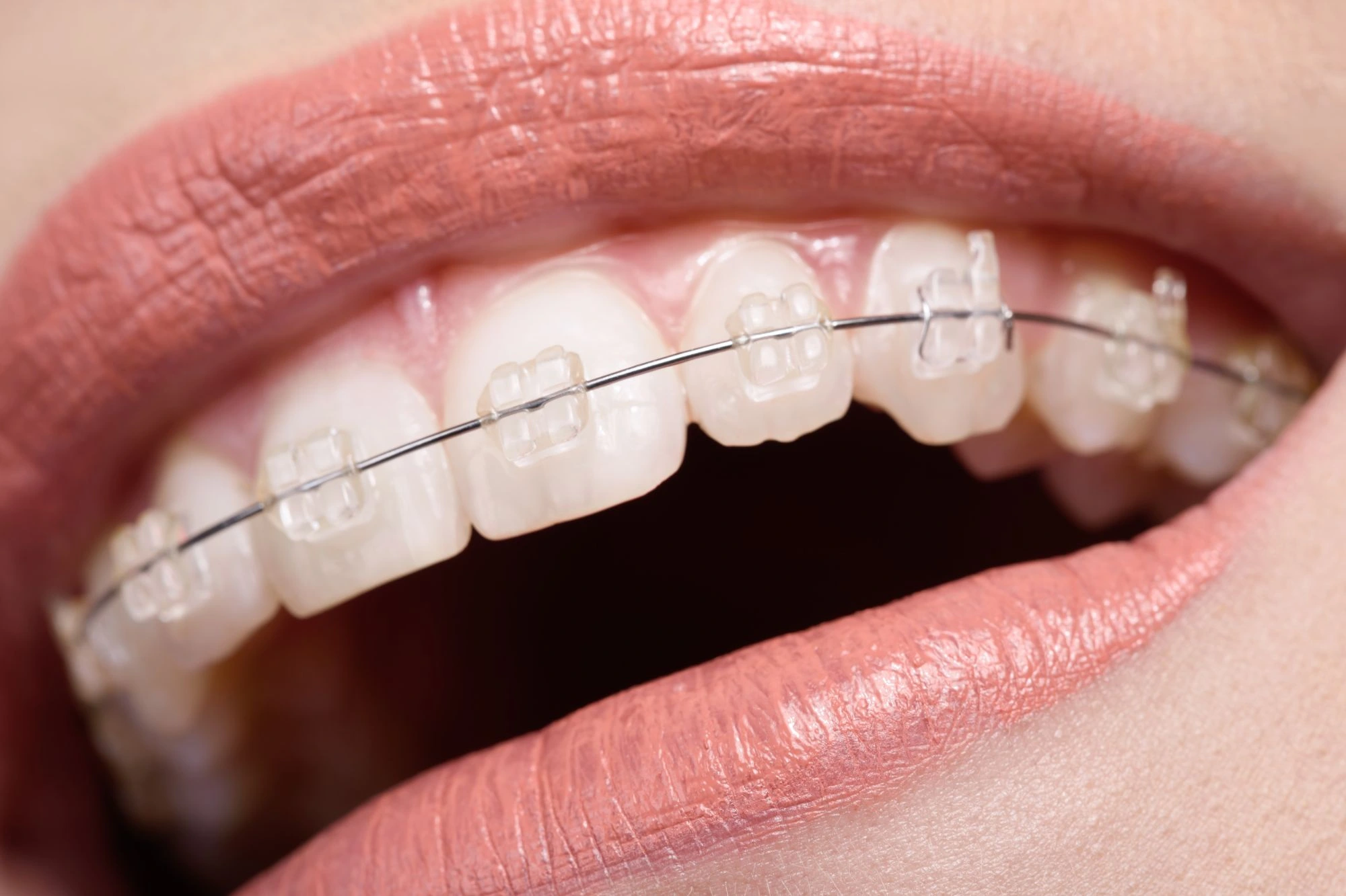 Ceramic Braces Images