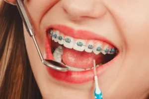 Choosing The Right Type of Braces Images