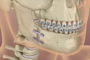 orthognatic surgery Image